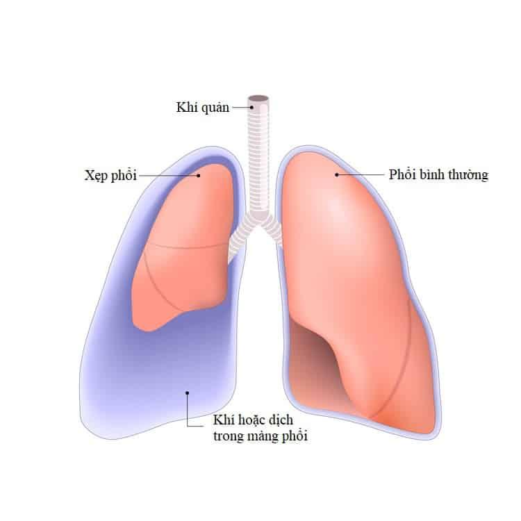 Tràn dịch màng phổi