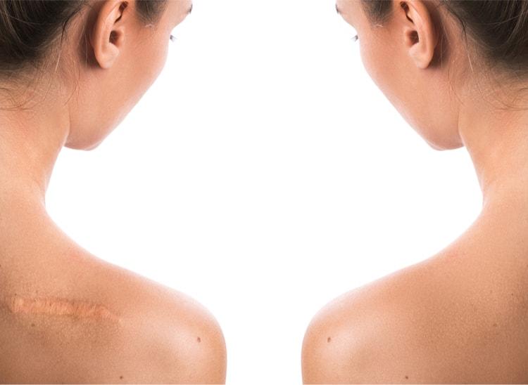5 loại thuốc trị sẹo hiệu quả được nhiều người đánh giá cao