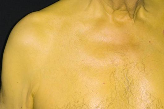 Hội chứng Gilbert