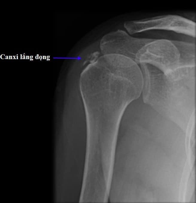 Bạn đã hiểu rõ về vôi hóa sụn khớp và gân cơ?