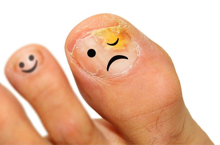 Nấm móng chân: Ai dễ mắc? Nguyên nhân và cách điều trị là gì?