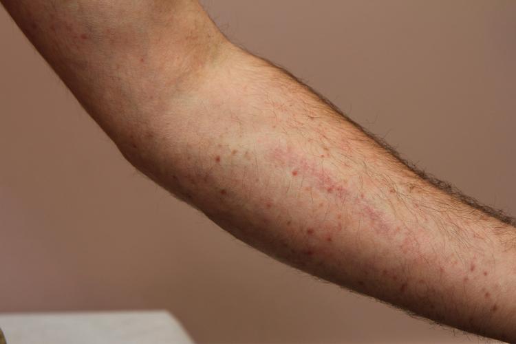 Tế bào mast hệ thống