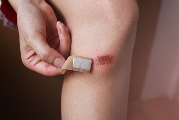 Bị trầy xước nên làm gì? Cách xử lý vết thương ngoài da