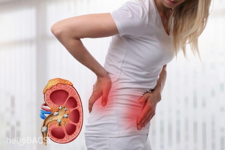 Sỏi thận có nguy hiểm không? Điểm danh các biến chứng cần dè chừng