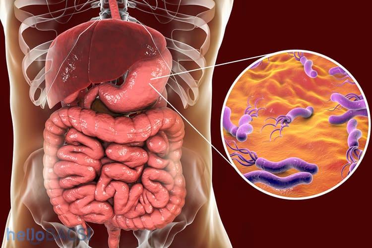 Bạn đã biết vi khuẩn Hp lây qua đường nào chưa?