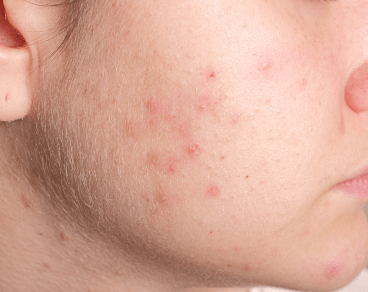 Mụn bọc ở má: Không cẩn thận sẽ lây lan nhanh, kém xinh đẹp