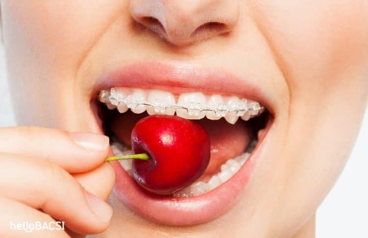 Niềng răng hô làm sao cho xứng đáng với giá tiền bạn bỏ ra?