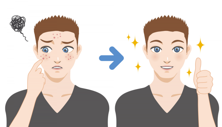 Trị thâm mụn cho nam cách nào?