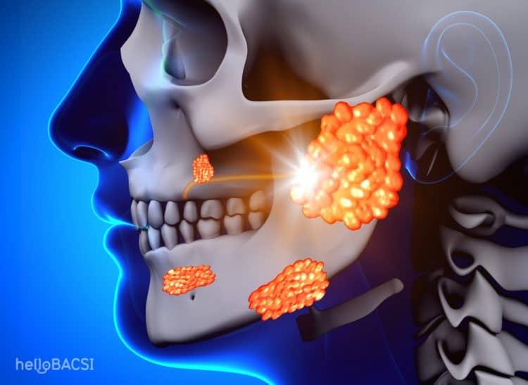 Những điều cần biết về bệnh quai bị ở người lớn