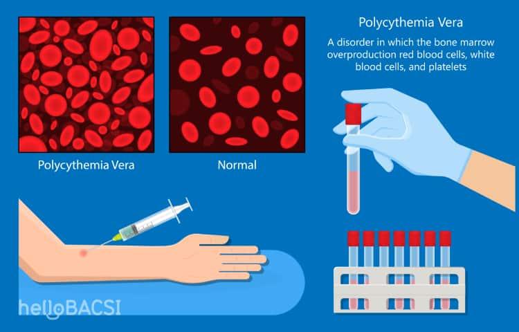 Triệu chứng và cách điều trị bệnh đa hồng cầu