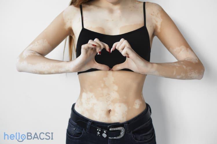 Khám phá những cách chữa bệnh bạch biến hiệu quả