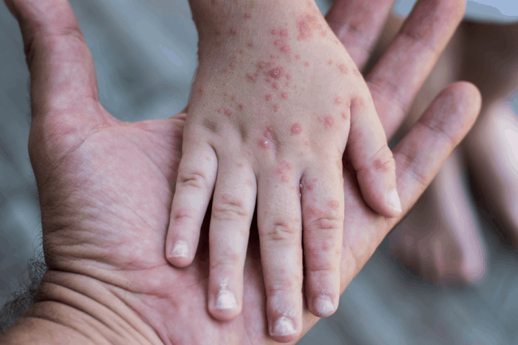 Thủy đậu và rubella không giống nhau như bạn nghĩ