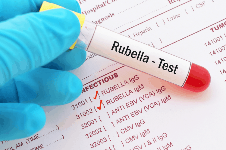 phuong-phap-xet-nghiem-rubella-chinh-xac