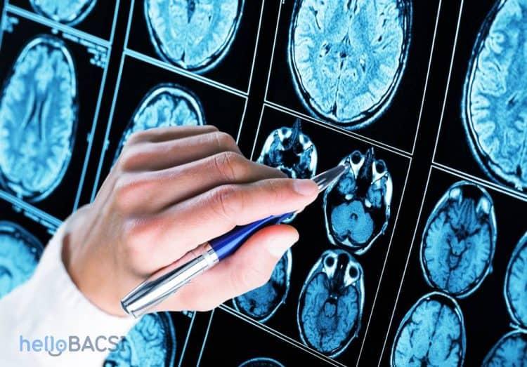 10 triệu chứng bệnh Alzheimer bạn có thể nhận biết sớm