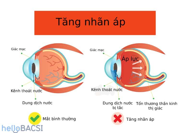 Nguyên nhân tăng nhãn áp trong bệnh glôcôm, triệu chứng và cách phòng ngừa