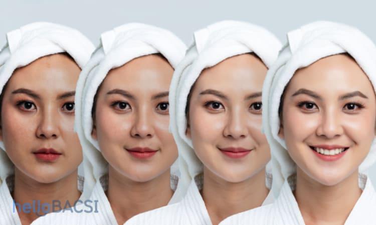 Thay da hóa học trị sẹo mụn: Những điều bạn cần biết