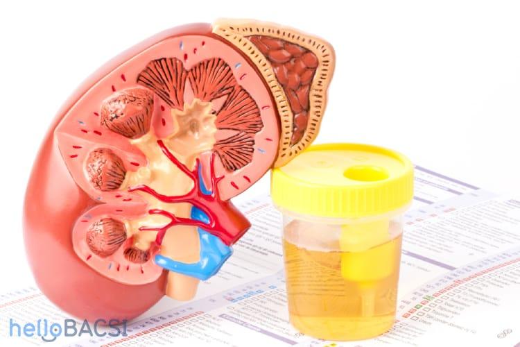 Điều trị bệnh thận ứ nước: Thoát nước tiểu là ưu tiên hàng đầu