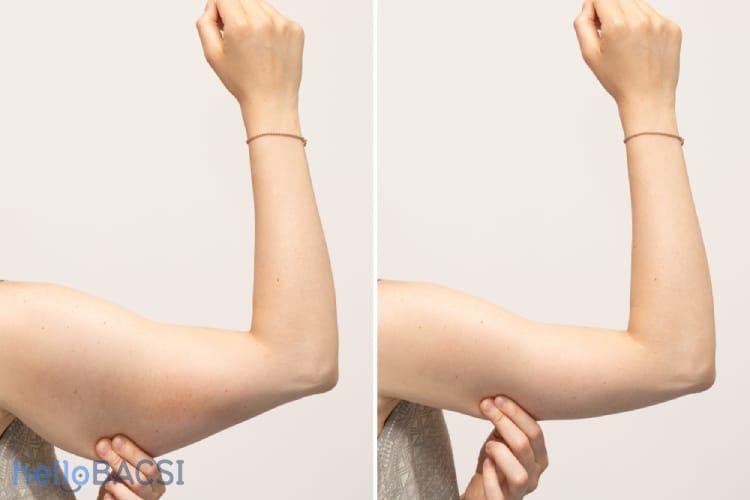 Phẫu thuật thẩm mỹ cánh tay