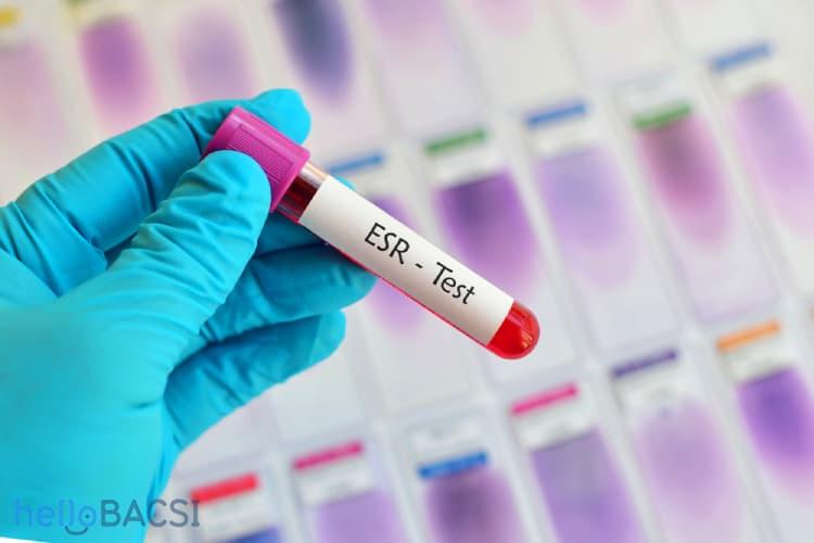 Xét nghiệm tốc độ lắng hồng cầu