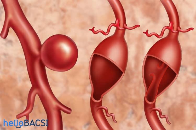 Chứng phình mạch