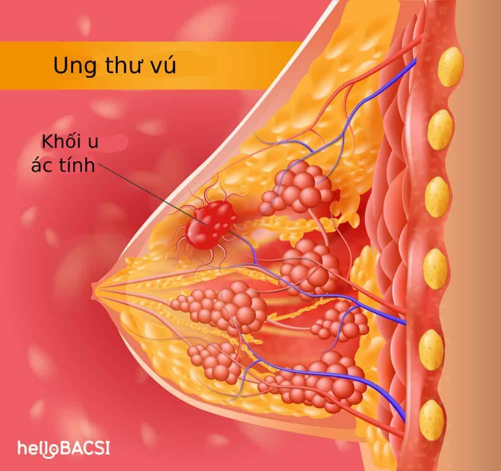 dau-hieu-ung-thu-vu