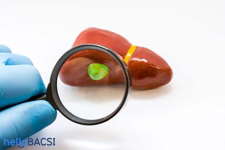 Tìm hiểu người bị polyp túi mật kiêng ăn gì?