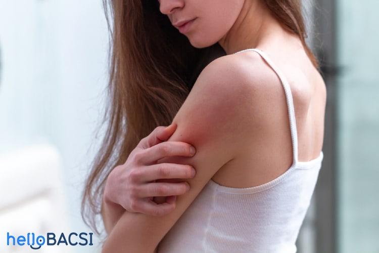 Hiện tượng Koebner trong bệnh vảy nến