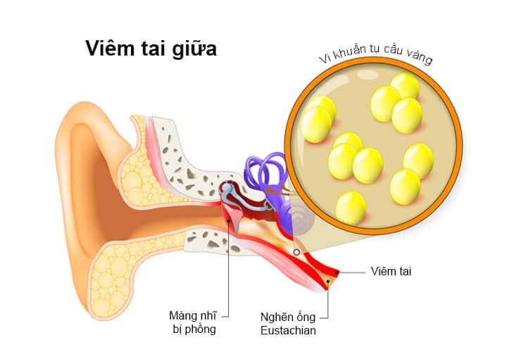 dau-hieu-viem-tai-giua-de-nhan-biet-nhat-va-bien-chung-cua-benh