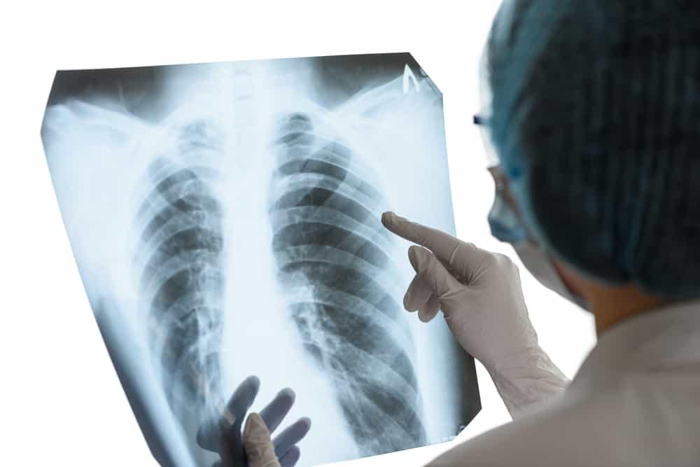 Nguyên nhân, triệu chứng và cách điều trị tràn khí màng phổi