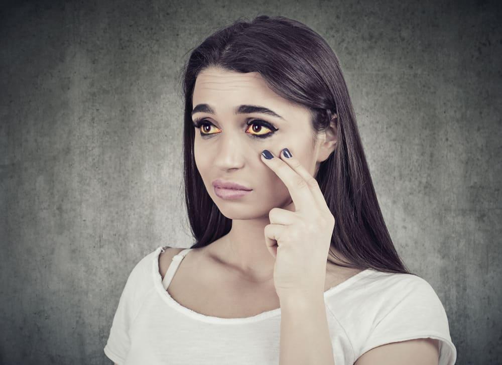 4 dấu hiệu trên da cho thấy bạn đang mắc bệnh gan