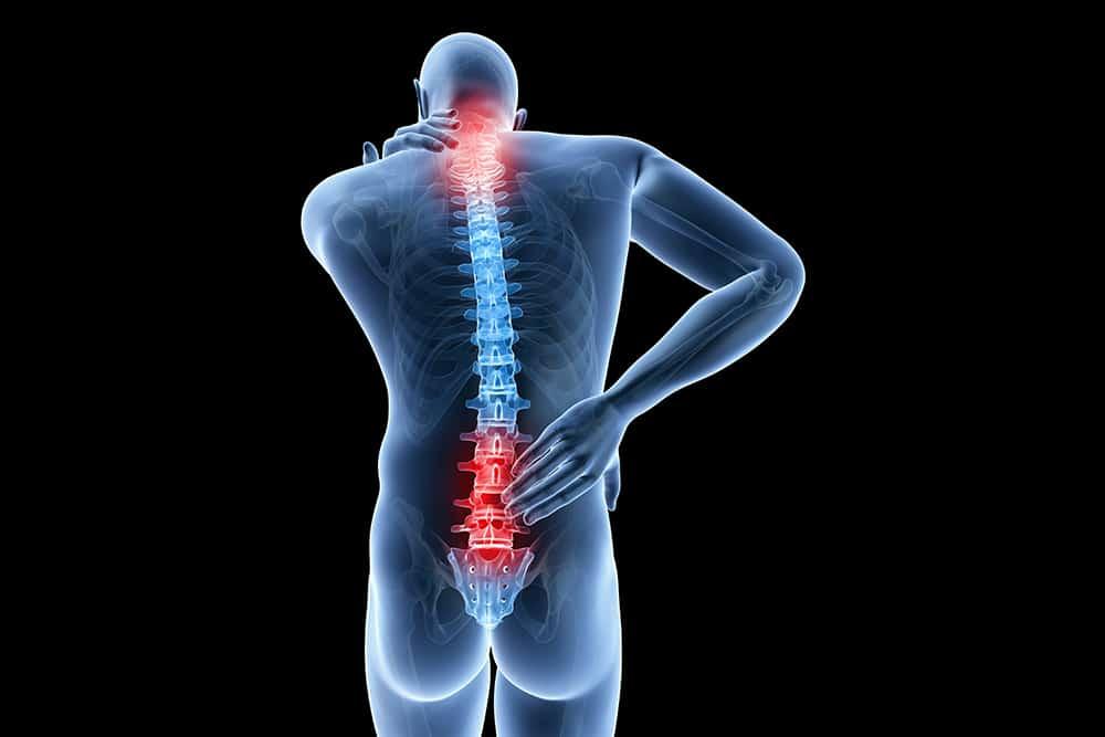 Đau lưng kiểu viêm: triệu chứng đặc trưng của viêm cột sống dính khớp