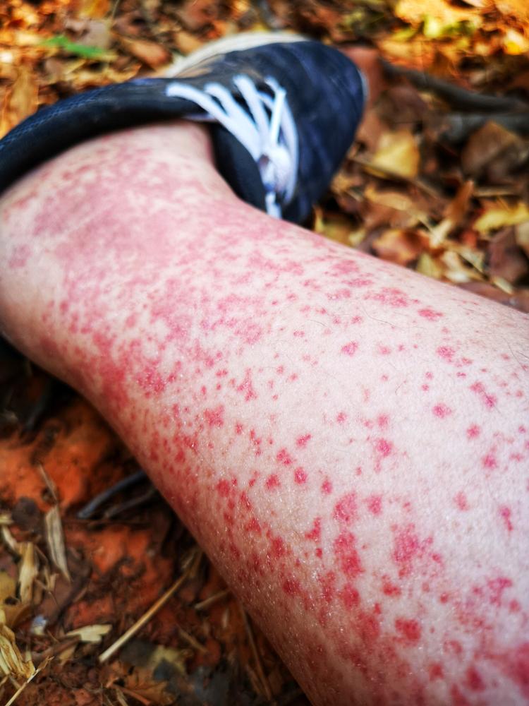 Viêm mao mạch dị ứng có chữa được không, có nguy hiểm không?