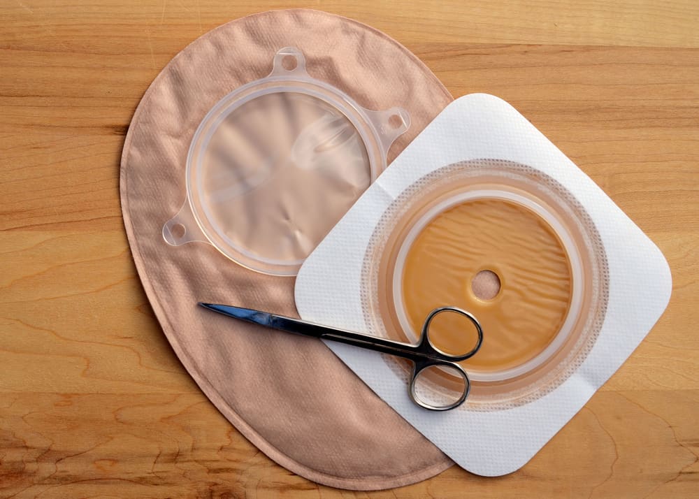 6 điều cần lưu ý khi chăm sóc hậu môn nhân tạo