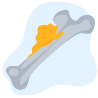 Ung thư xương