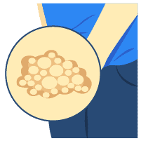 Mụn rộp sinh dục