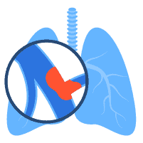 Thuyên tắc phổi