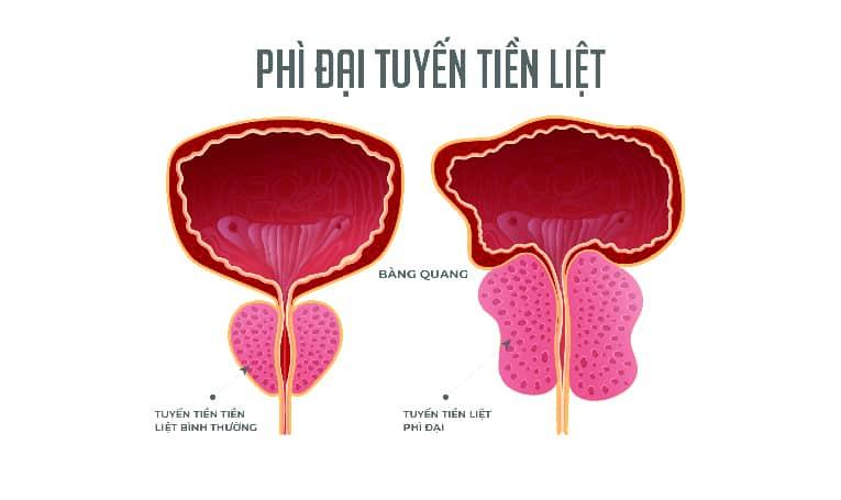 Phì đại tuyến tiền liệt có nguy hiểm không?
