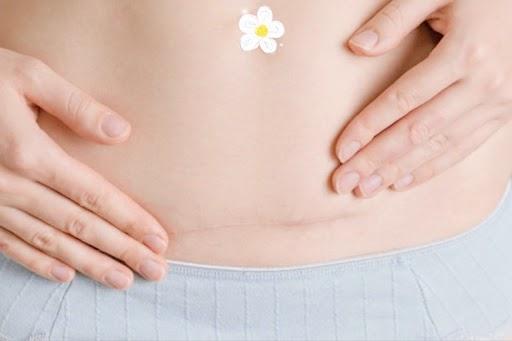 Mách mẹ cách chăm sóc trẻ sinh mổ để con phát triển tối ưu