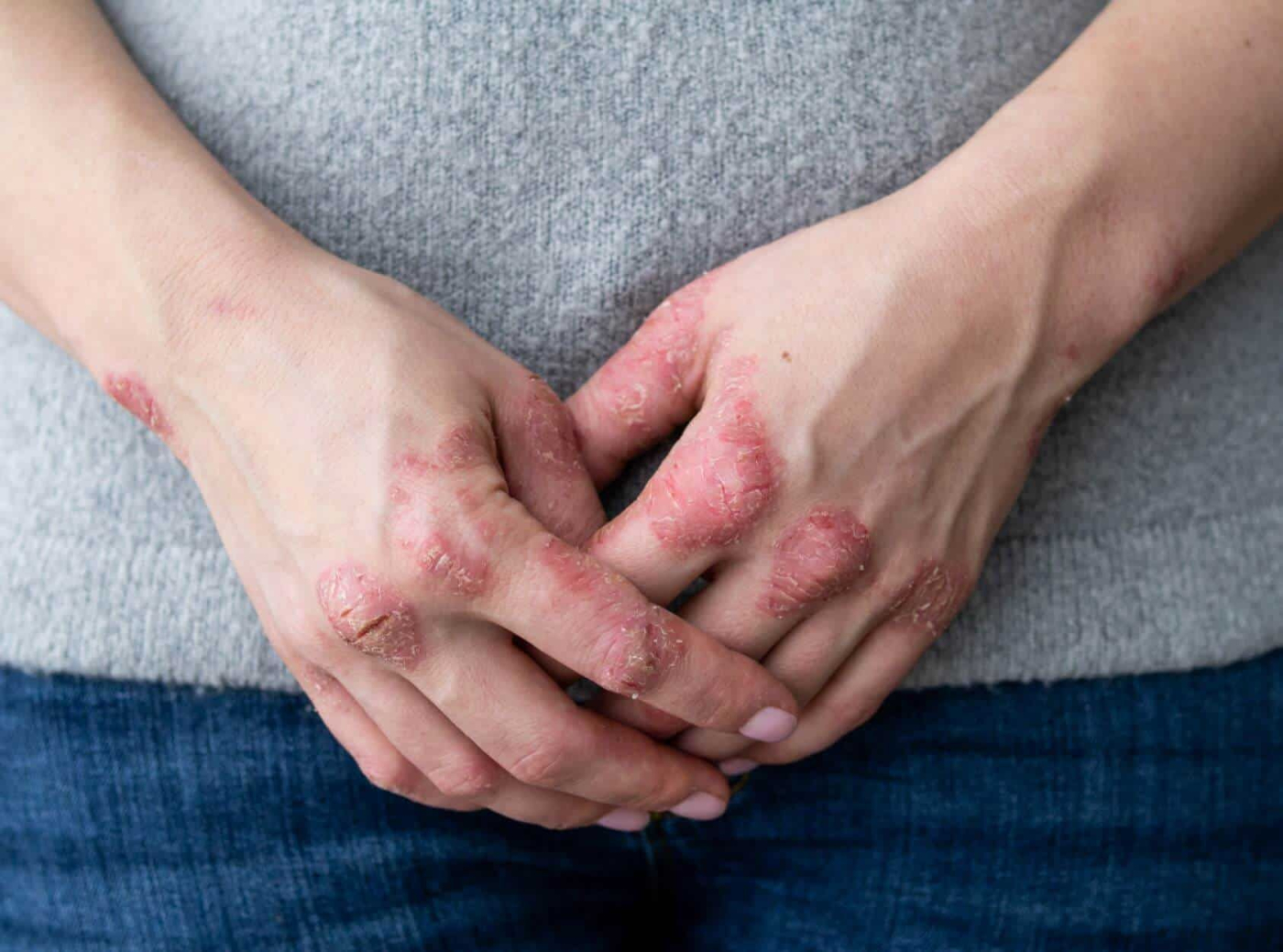 11 triệu chứng bệnh viêm khớp vảy nến không thể bỏ qua