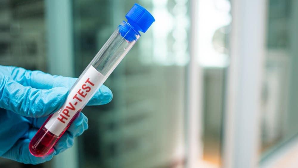 8 câu hỏi thường gặp về nhiễm virus HPV ở nam giới