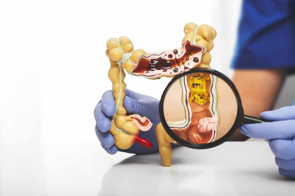 cat-polyp-dai-trang