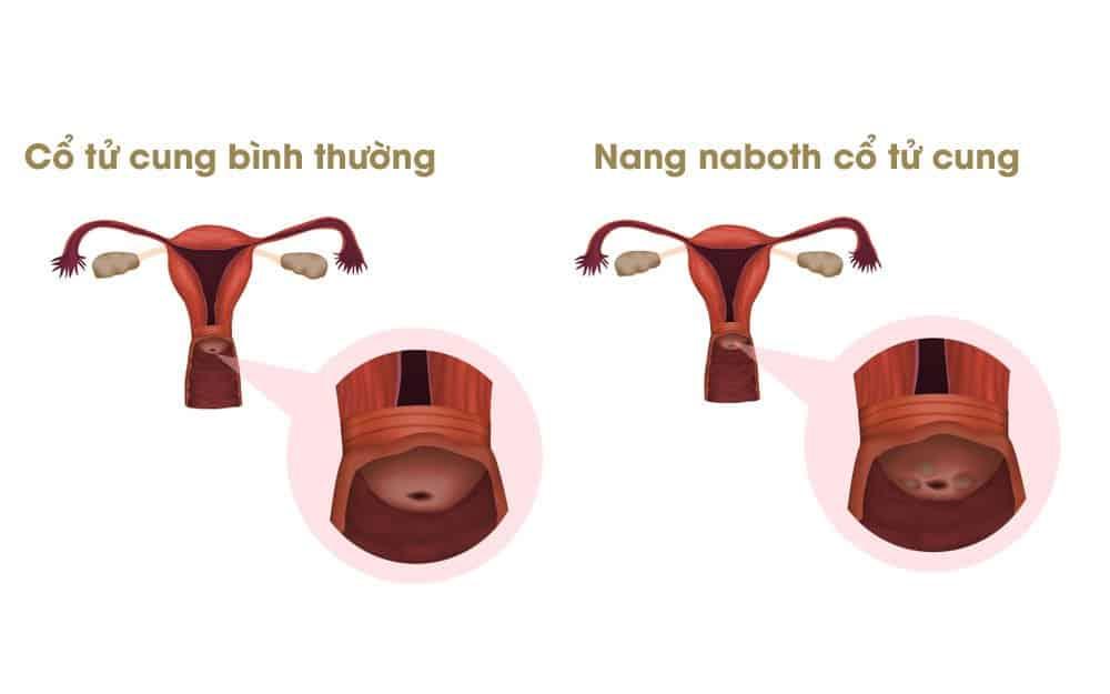 Nang naboth cổ tử cung – Bệnh phụ khoa phổ biến ở phụ nữ