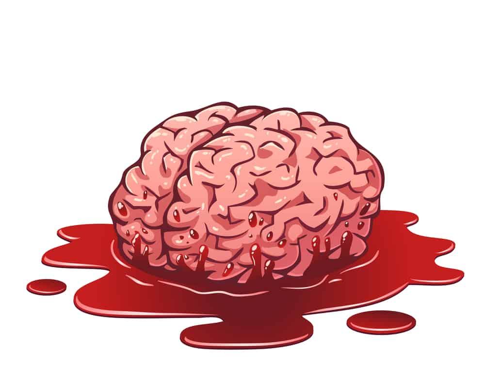 Tụ máu não là gì? Nguyên nhân, triệu chứng và điều trị