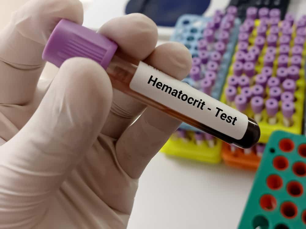 Hct là gì? Xét nghiệm chỉ số hct trong máu và những điều bạn cần biết