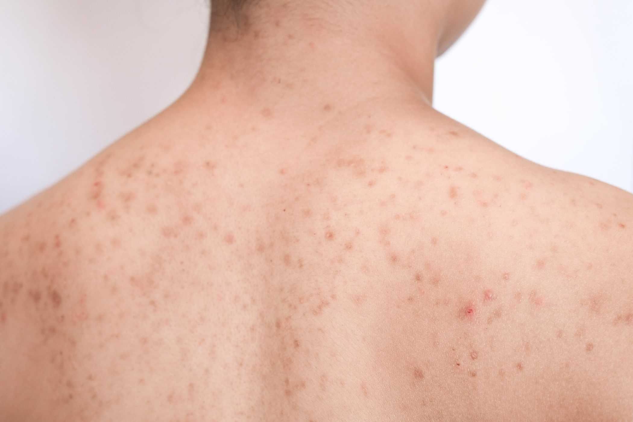 Nguyên nhân mụn lưng và 8 cách điều trị tại nhà hiệu quả