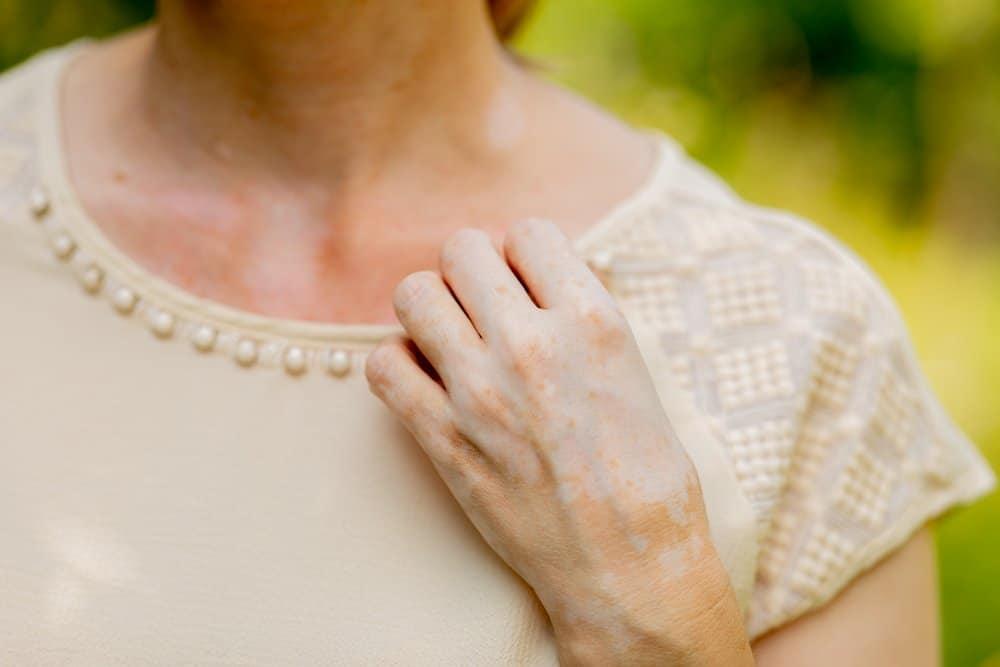 Nám da tay: Nguyên nhân và cách điều trị tại nhà