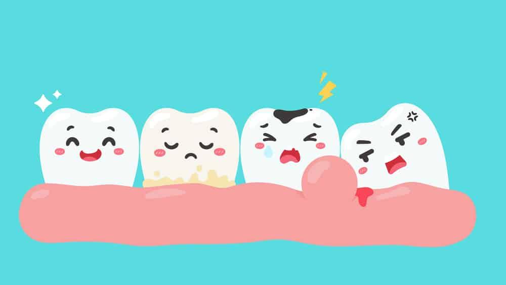 Áp xe nha chu: Chớ xem thường vấn đề sức khỏe răng miệng này!