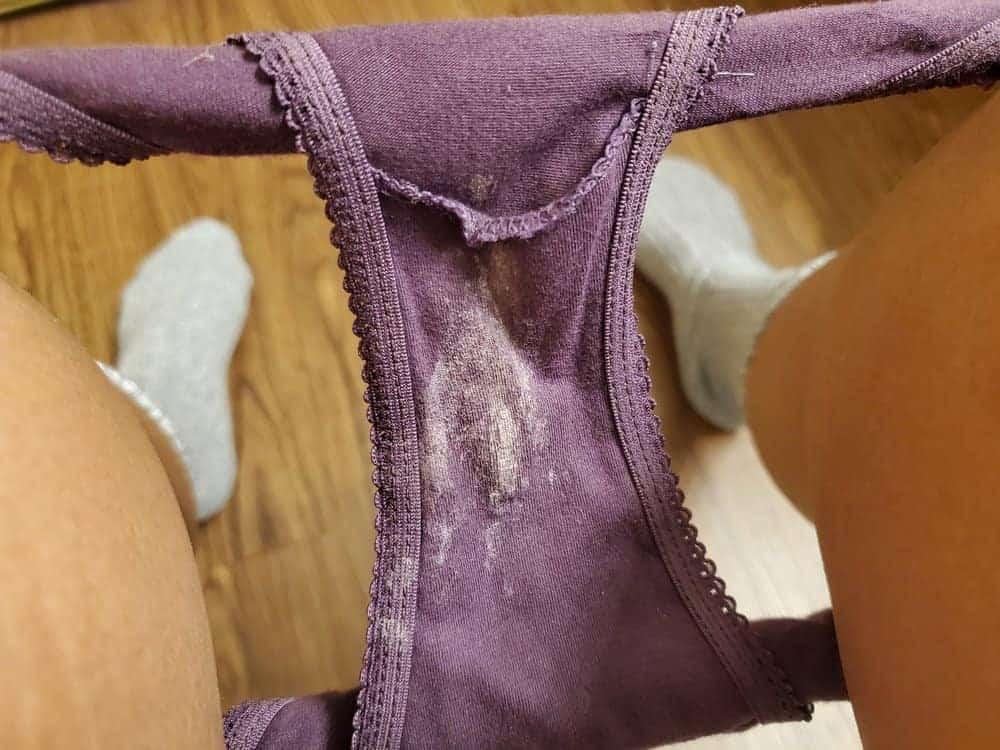 Khí hư màu trắng sữa có nguy hiểm? Nguyên nhân, điều trị, phòng ngừa