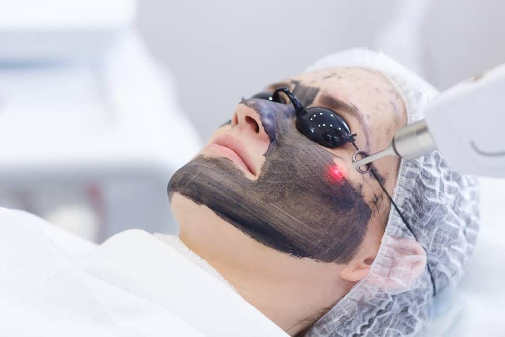 Laser carbon peel là gì? Bắn laser carbon có tốt không?