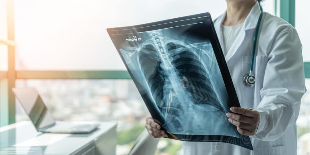 Chụp X quang tràn dịch màng phổi có giúp chẩn đoán bệnh?